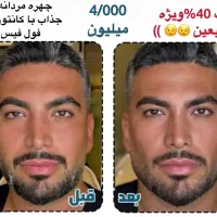 تزریق ژل لب بوتاکس کانتورینگ صورت جوانسازی لیفت|خدمات آرایشگری و زیبایی|تهران, صادقیه|دیوار