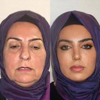 جراحی عمل بینی ۲۴ میلیونی/رینوپلاستی/بینی فانتزی|خدمات آرایشگری و زیبایی|تهران, مطهری|دیوار