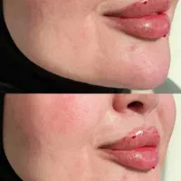 تزریق ژل و بوتاکس۶۹۹تومن
