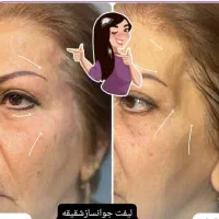 تزریق هرنوع خدمات زیبایی به صورت تضمینی|خدمات آرایشگری و زیبایی|کارون, |دیوار