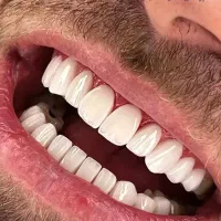 دندانپزشکی کامپوزیت با آفر ویژه تا ده روز اینده|خدمات آرایشگری و زیبایی|ارومیه, |دیوار