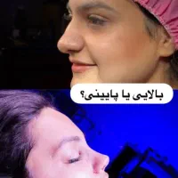 آف زمستانه بمدت محدود عمل بینی 23ملیون