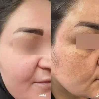 پکیج اقتصادی روشن کننده‌باتیرگی صورتت‌خداحافظی کن