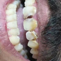 کامپوزیت هرفک 7/900 8واحد جرم گیری ترمیمم ریموو