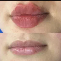 اف  انواع تزریق ژل باکمترین قیمت پاک کردن ابرو