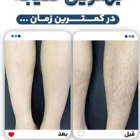 لیزر موج کندلا لیزر بانوان  لیزر آقایان لیزر خانم|خدمات آرایشگری و زیبایی|اصفهان, باغ زرشک|دیوار