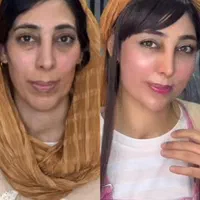 لیفت و جوانسازی صورت با ارزان ترین قیمت توسط پزشک|خدمات آرایشگری و زیبایی|مشهد, هنرستان|دیوار