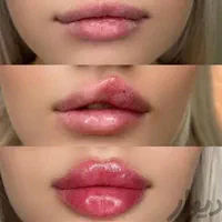 جشنواره  فیلر بادی،اگزوزوم، نخ،ژل بایوفیلرپی ار پی