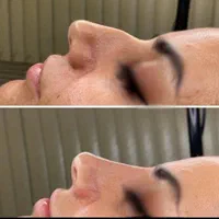 فیلر بینی  برطرف کردن قوز بینی  بینی شکسته و کج|خدمات آرایشگری و زیبایی|خرم‌آباد, |دیوار