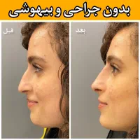 آف فرمدهی بینی بدون عمل جراحی پزشک پوست مو زیبایی|خدمات آرایشگری و زیبایی|مشهد, هفت تیر (آب و برق)|دیوار