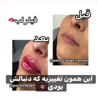 لیزرشاتی الکساندرایت نابلکس ،کاشت ابرو،بوتاکس و..