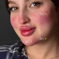 افرتزریقات ژل و بوتاکس