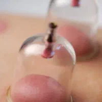 حجامت و فصد خون