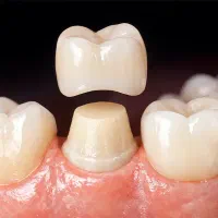عصب کشی و روکش با نرخ دولتی