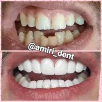 کامپوزیت دندان درمحل شمامنزل یامحل کار|خدمات آرایشگری و زیبایی|هشتگرد, شهرک گلخانه|دیوار