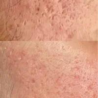 اموزش درمان لک و اسکار