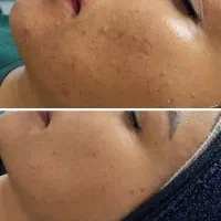 تخفیف ویژه پاکساژی و ماساژ صورت|خدمات آرایشگری و زیبایی|سقز, |دیوار