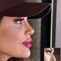 عمل بینی رینوپلاستی کلینیک مهرزاد