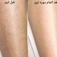 لیزر موهای زائد و پاک کردن تتو و خالبرداری