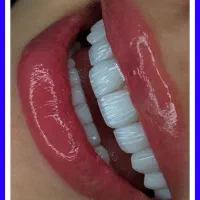 کامپوزیت/دندانپزشکی/عصبکشی/لیرینگ/ترمیم پالیش|خدمات زیبایی و سلامت|تهران, تهرانپارس شرقی|دیوار