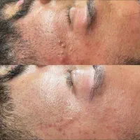 پاک کردن تتو ابرخط چشم بدن کربن پیلینگ کربوکسی ۸۰۰|خدمات آرایشگری و زیبایی|شیراز, ملاصدرا|دیوار