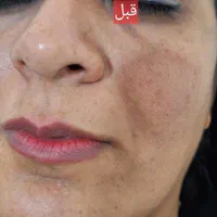 کربن تراپی صورت و بدن|خدمات آرایشگری و زیبایی|فردیس, فردیس|دیوار