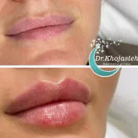 جشنواره ژل لب و بوتاکس ۸۵۰