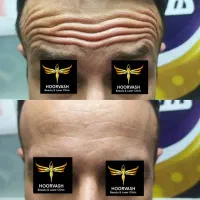 بوتاکس فیلر مزو نخ پی آر پی چربی جوانسازی بدون عمل|خدمات آرایشگری و زیبایی|کرج, گلشهر|دیوار