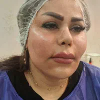 تزریق چربی ،فیلر بادی،عمل پلک،ژل و بوتاکس|خدمات آرایشگری و زیبایی|تهران, صادقیه|دیوار