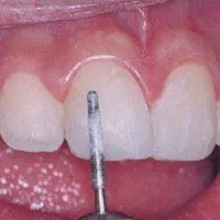 آموزش کامپوزیت دندان