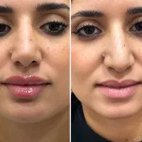 سرم لیفت بینی ،کرم بیوممتیک ،لاکچری کوین