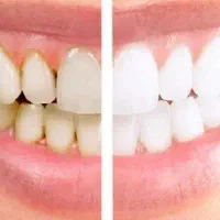 جرمگیری و بلچینگ دندان جشنواره تخفیف ویژه پاییزی