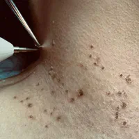 برداشتن گوشت اضافه صورت وبدن|خدمات آرایشگری و زیبایی|اصفهان, کوجان|دیوار