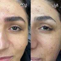 میکروبلیدینگ‌ میکروبلید هاشور فیبروز فیبروزابرو|خدمات آرایشگری و زیبایی|اصفهان, سعادت‌آباد|دیوار