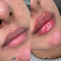 تزریق ژل لب توسط پزشک با تجربه