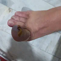 ناخن ،  شستشوی گوش ، سوراخ کردن گوش