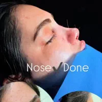 جراحی بینی فقط ۸و۹ آذر فقط۲۹ میلیون تومان|خدمات آرایشگری و زیبایی|فریدونشهر, |دیوار