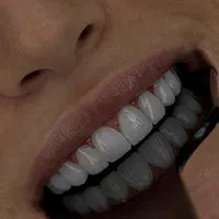 جشنواره ویژه پاییزی کامپوزیت دندان|خدمات آرایشگری و زیبایی|تهران, افسریه جنوبی|دیوار