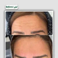 اف ویژه بوتاکس تعداد محدود|خدمات آرایشگری و زیبایی|یاسوج, |دیوار