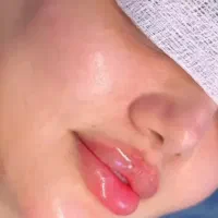 اف ژل و بوتاکس فقط 500