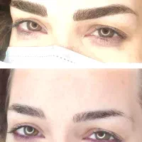 ریموو ابروتک جلسه ای تضمینی با متریال انحصاری