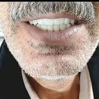 دندان کامل(شرایطی ویژه)|خدمات آرایشگری و زیبایی|سلطانیه, |دیوار