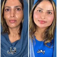 تخفیف فیلر هر سی سی ۴۵۰ مدت ۳روز