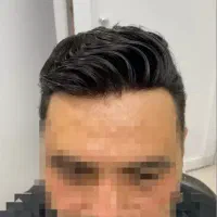 پروتز مو ماکروپوینت (کاشت موقت)