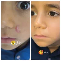 لیفت شقیقه،جای زخم(اسکار) بلفاروبوتاکس فیلر|خدمات آرایشگری و زیبایی|اهواز, زیتون کارگری|دیوار