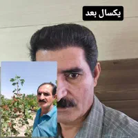 کاشت موی سر و ابرو