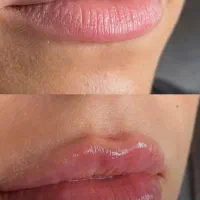 هایفوتراپی جوانسازی پوست بادستگاه ۱۲بعدی|خدمات آرایشگری و زیبایی|کرمانشاه, |دیوار