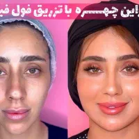 بوتاکس پیشانی خط اخم رایگان شد روز یکشنبه