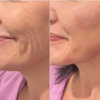 با چروکهای صورتت خداحافظی کن