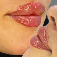 تمام تزریقات زیبایی با قیمت و کیفیت استثنائی